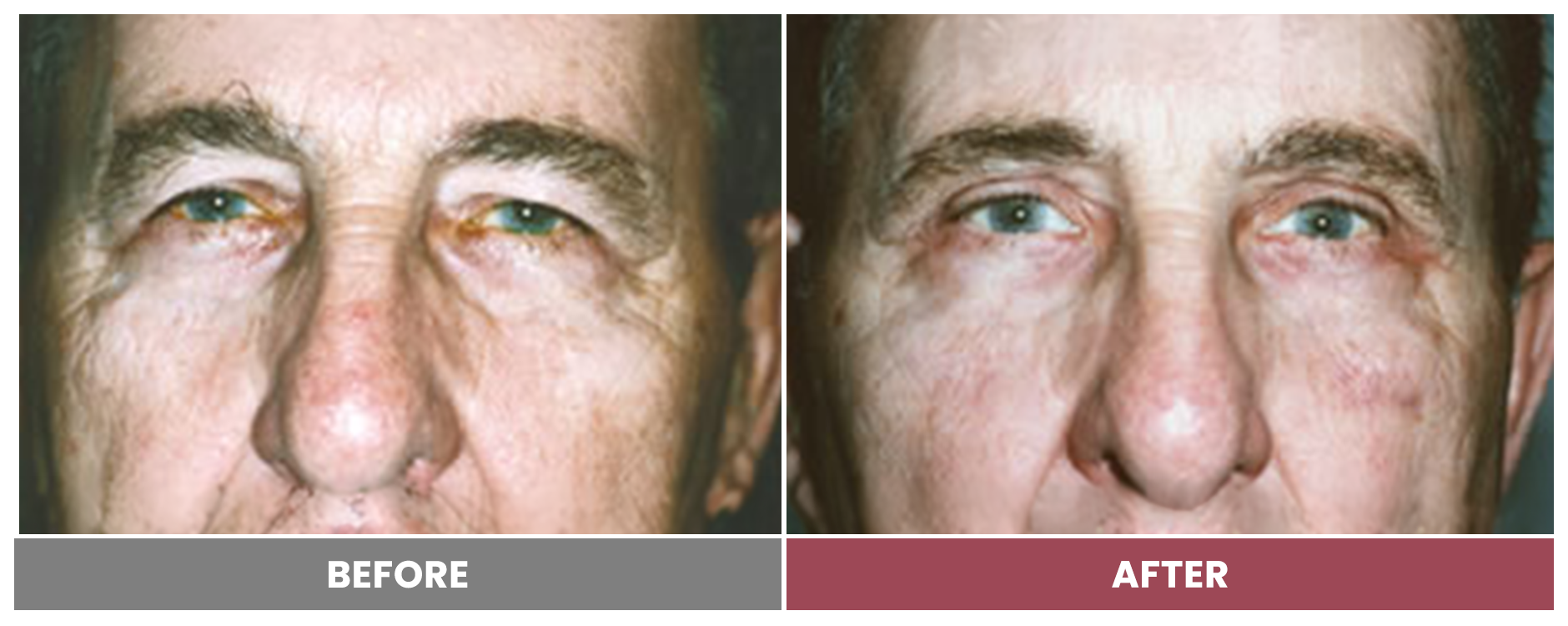 Upper Blepharoplasty - Case 61